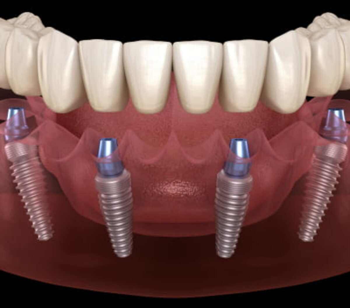 Treatment - Infinity Dental Solihull
