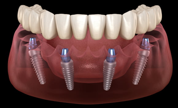 Treatment - Infinity Dental Solihull