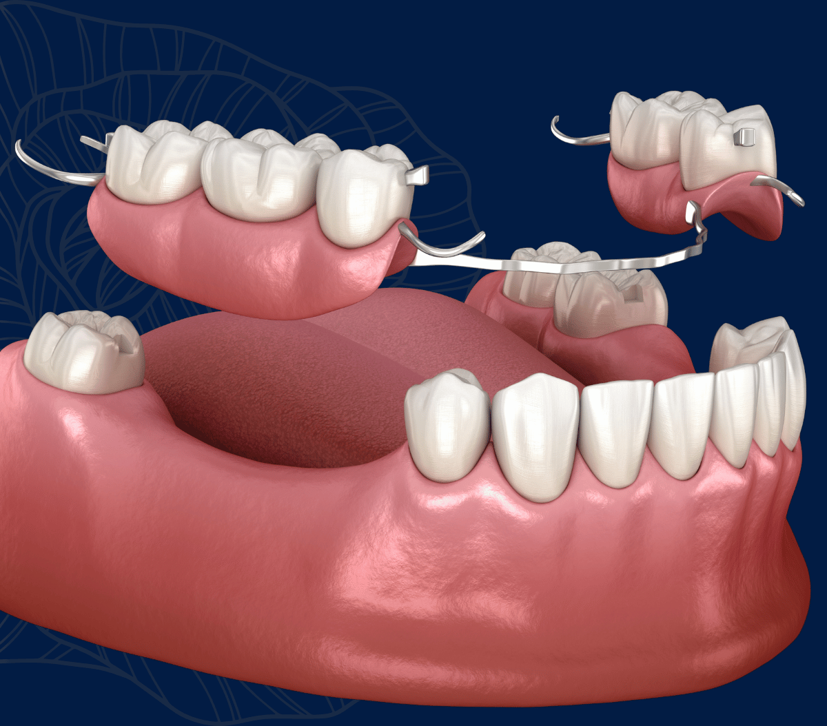 Treatment - Infinity Dental Solihull