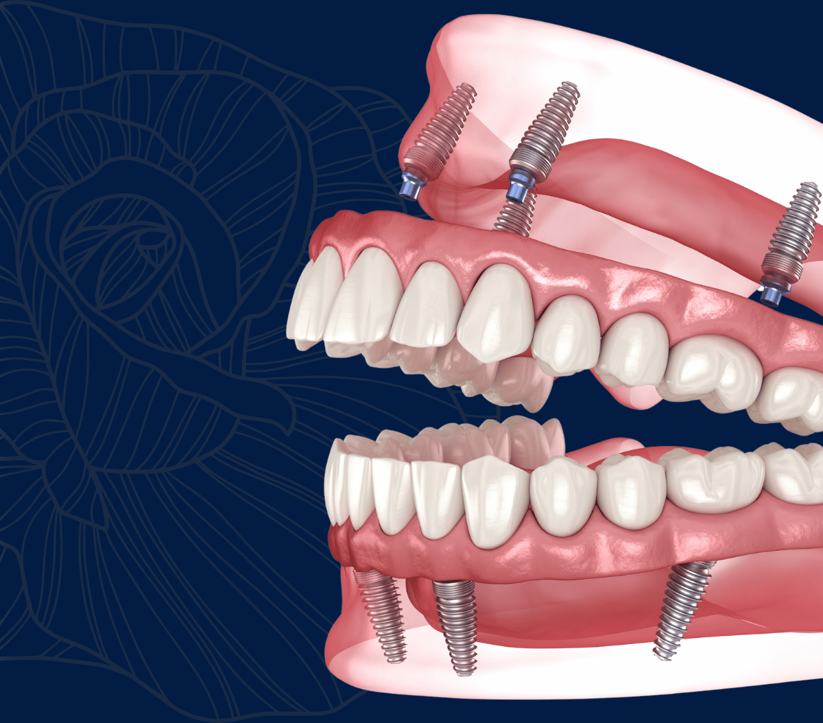 Treatment - Infinity Dental Solihull