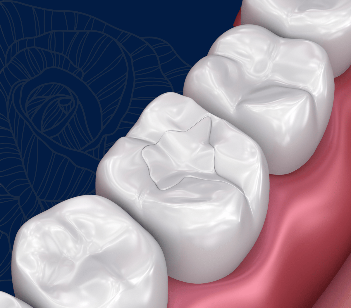 Treatment - Infinity Dental Solihull